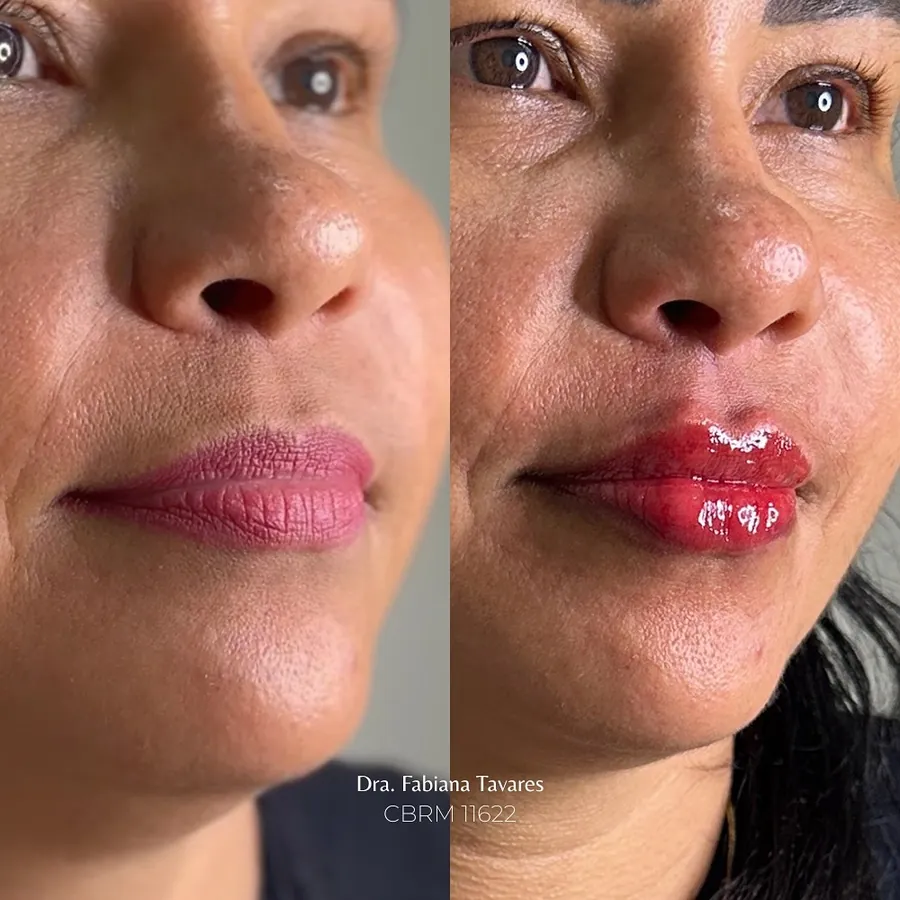 Lábios antes e depois do preenchimento